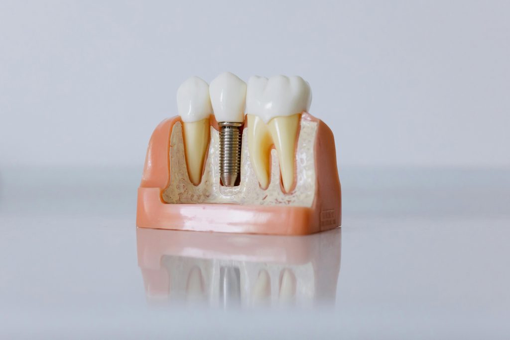 Smart Care for Dental Implants - Dental Implants Cost