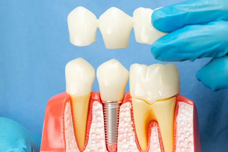 Choosing the right dental implant system for a healthy, lasting smile