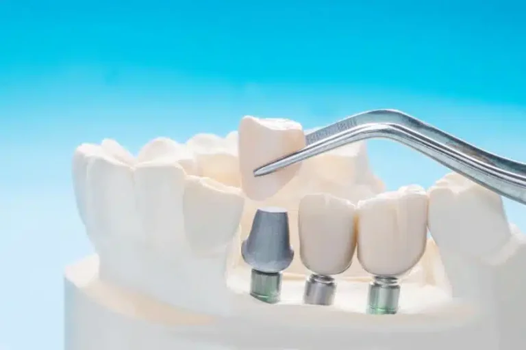 Teeth Implants