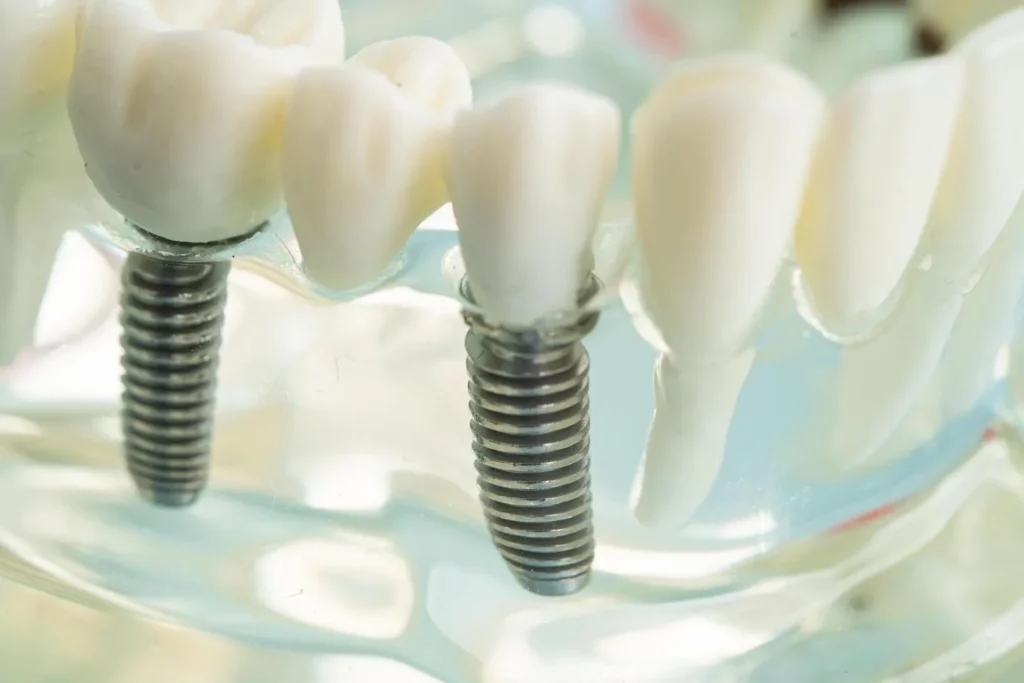 All-on-4 dental implants showing artificial tooth roots placed securely in the jawbone