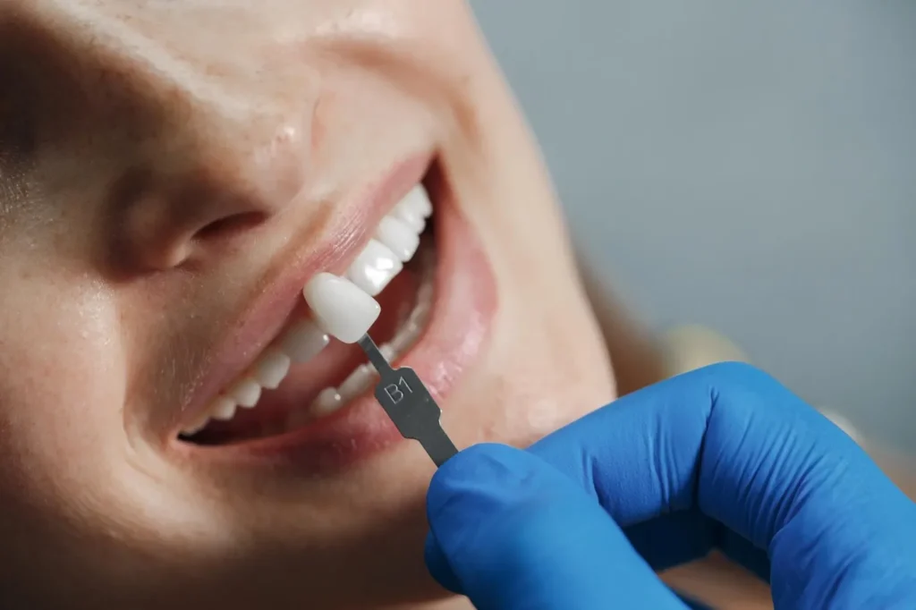 Dentist fitting a dental crown to restore a damaged tooth