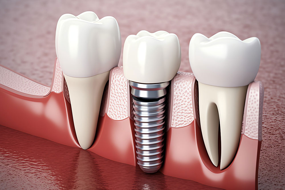 alt="Modern dental implant model supporting artificial tooth for missing gap