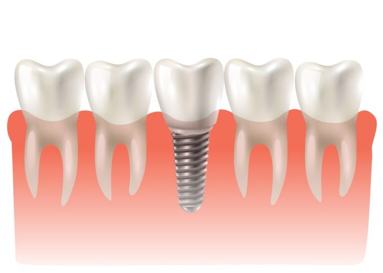 Dental implant crown placed in between natural teeth, restoring a missing tooth