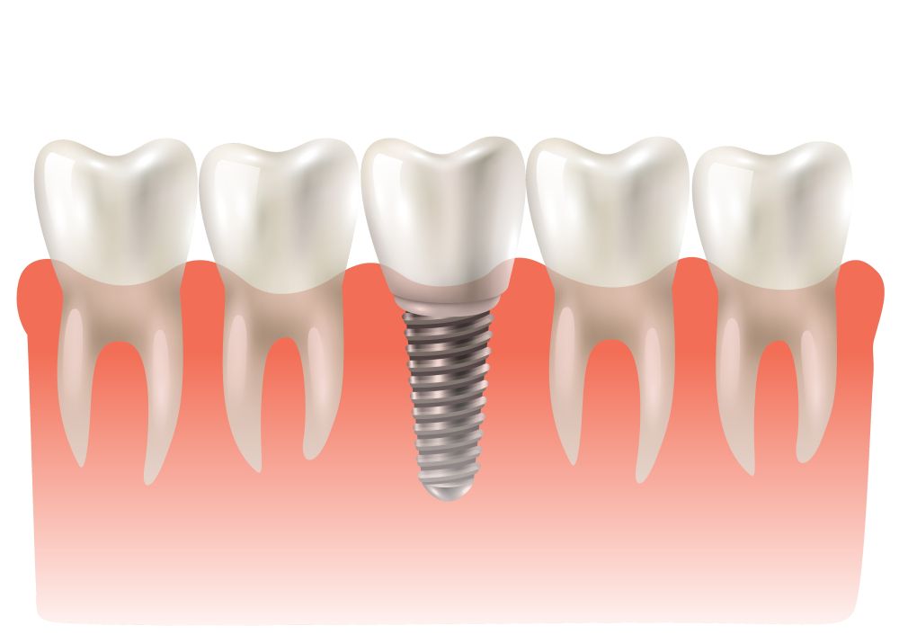 Dental implant crown placed in between natural teeth, restoring a missing tooth
