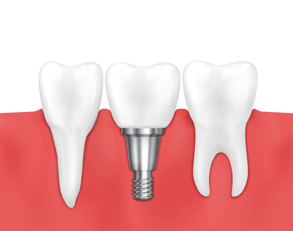 view of a dental implant next to a natural tooth in the jawbone